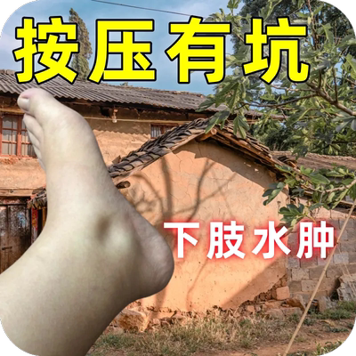 治疗脚肿水肿的药神器老人去下肢小腿部水肿浮肿利尿排水特效喷剂