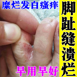 脚趾缝溃烂痒发白脚脱皮糜烂脚气膏真菌感染烂脚丫脚痒起皮水泡药