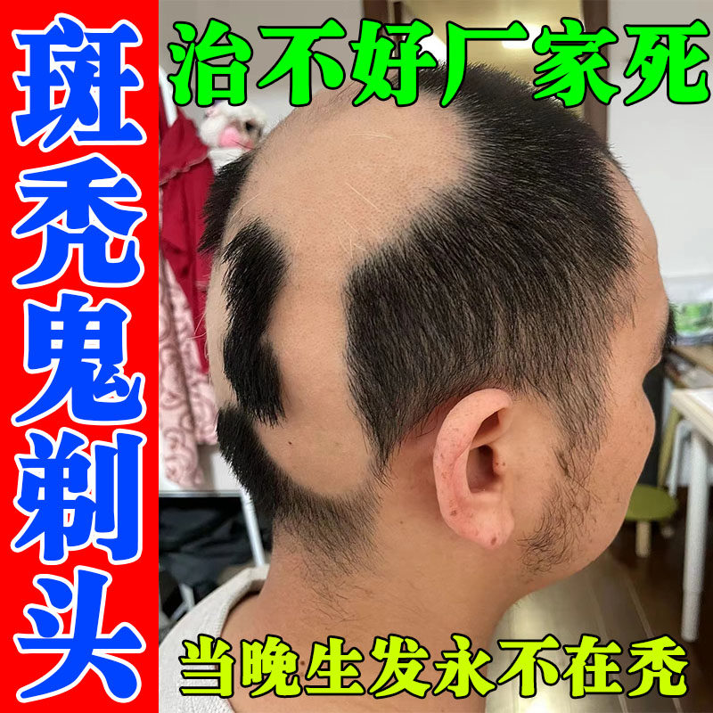 鬼剃头药斑秃液儿童斑秃成块掉地中海防脱育增发密发专用喷剂