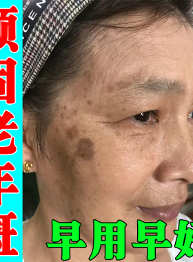 脸上黄褐斑老年斑雀斑脸上黑色素沉淀脸部黑点斑脸颊长斑点软膏