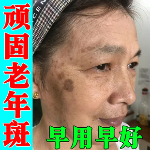 脸上黄褐斑老年斑雀斑脸上黑色素沉淀脸部黑点斑脸颊长斑点软膏