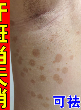 汗斑净去汗斑专用去胸前后背腋下白斑花斑褐色斑止痒膏杀菌