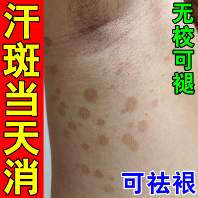 汗斑净去汗斑专用去胸前后背腋下白斑花斑褐色斑止痒膏杀菌