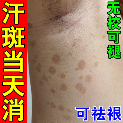 汗斑净去汗斑专用去胸前后背腋下白斑花斑褐色斑止痒膏杀菌