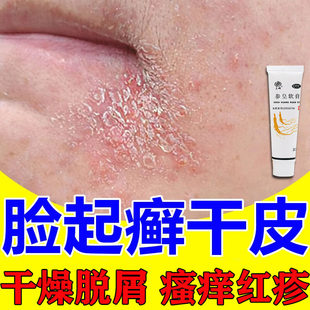 脂溢性皮炎面部皮肤干燥起皮脸上过敏皮肤修复脸部红痒参皇软膏AC