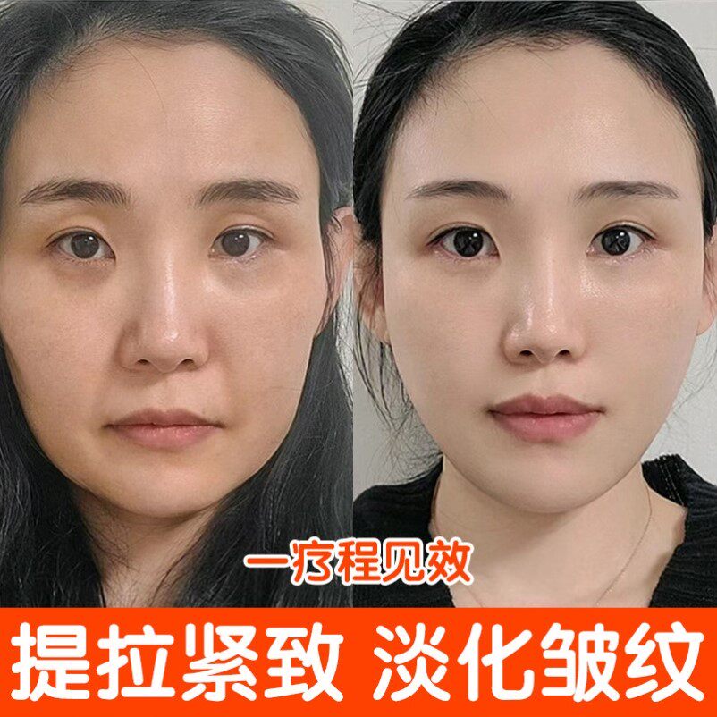 胶原蛋白填充霜重组霜去抬头纹法令纹男女抗皱紧提拉致保湿面霜