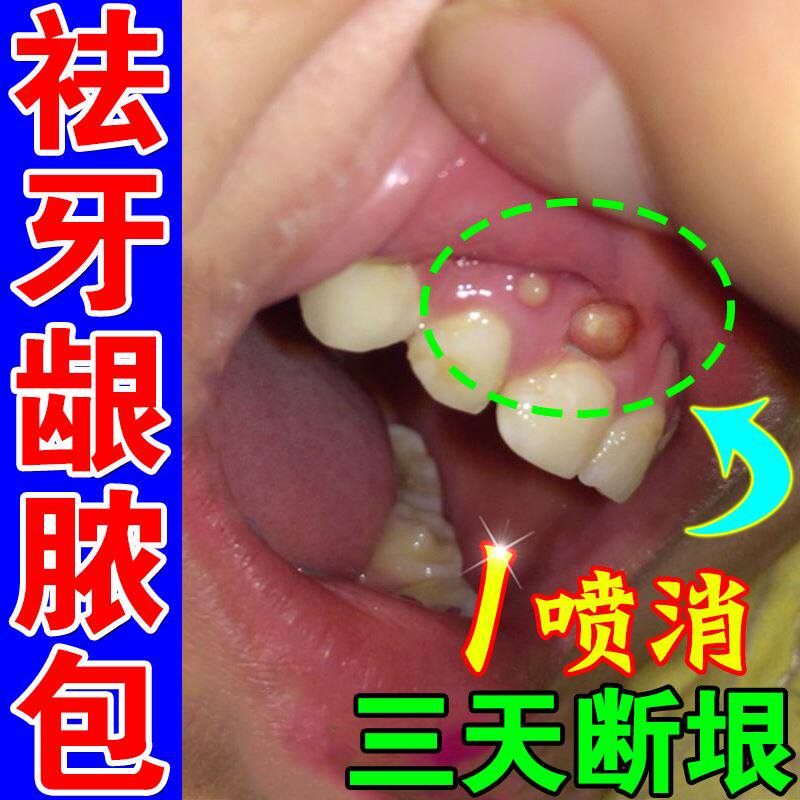 牙龈脓包肿包肿痛消焱上火智齿发炎牙根周炎鼓包出血专用药喷剂