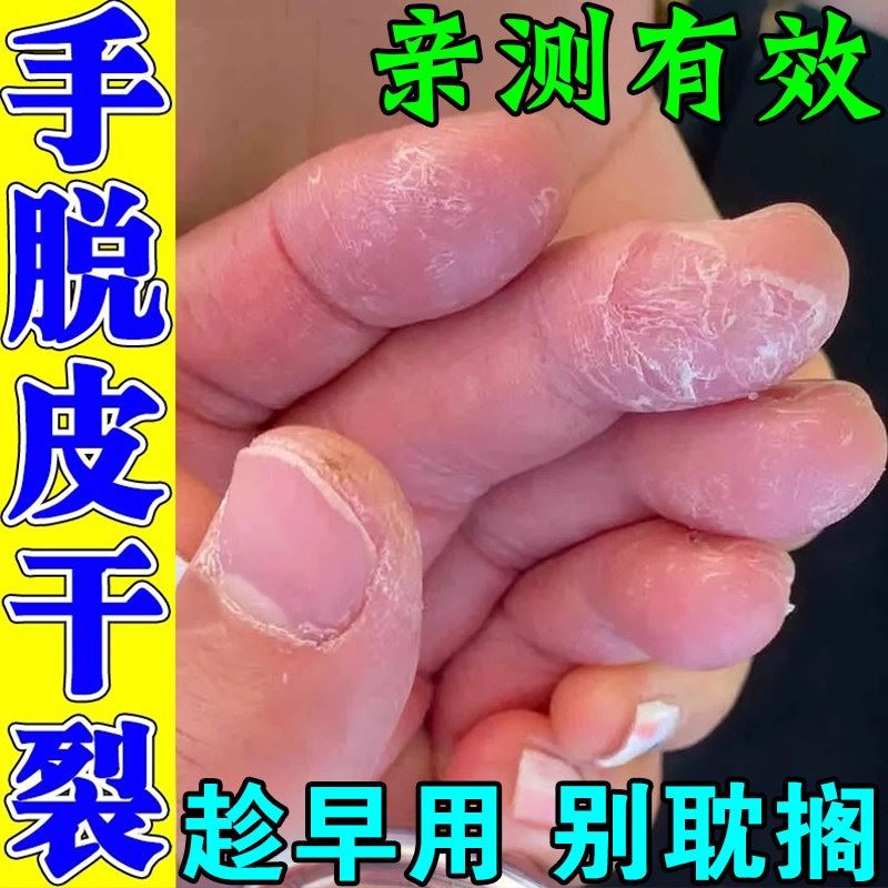 手脱皮干裂真菌蜕皮手上起皮干燥掉皮专用真菌掉皮脚底开裂护手霜