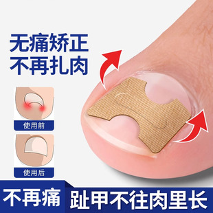德国甲沟矫正器炎正甲贴指甲贴片嵌甲脚趾甲往肉里长纠正填充垫片