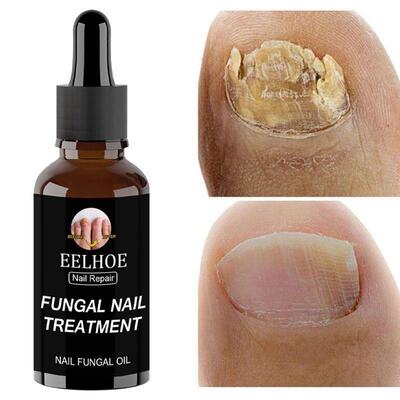 30ml Fungal Nail Repair Essence Feet CareTreatment Foot Toe