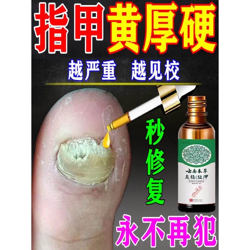 脚指甲发黄变厚增厚变硬真菌性白甲空甲床分离修复灰甲治疗专用药