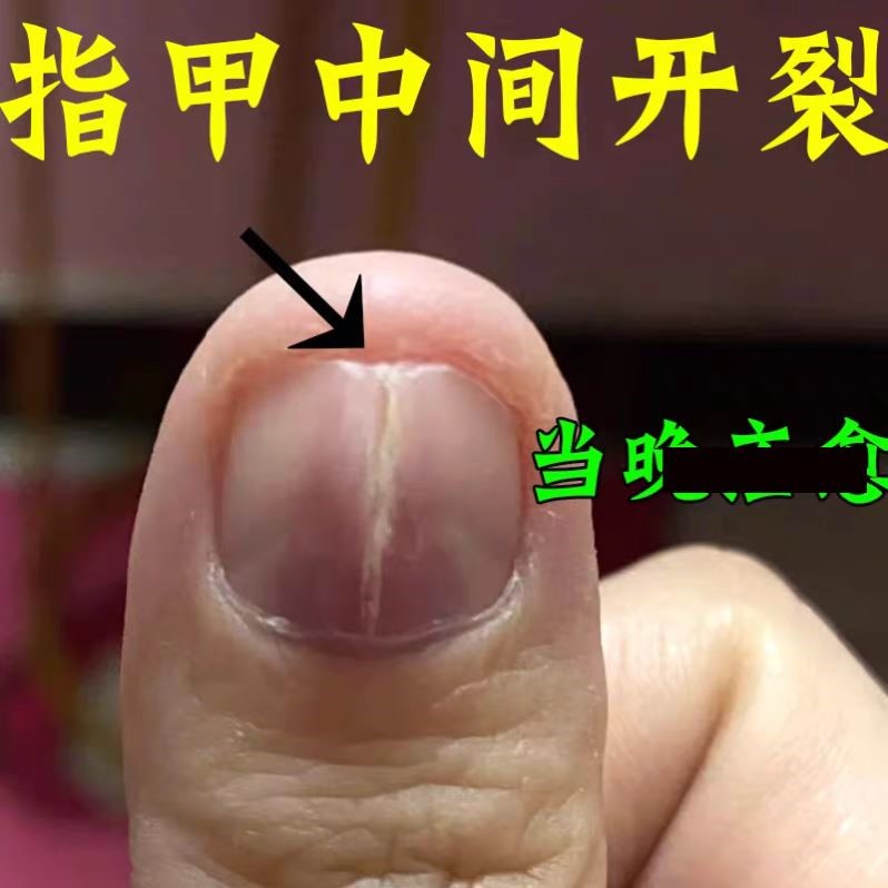 治指甲开裂修复竖条纹受损甲肉分离甲面分层空甲凹凸不平护甲营养