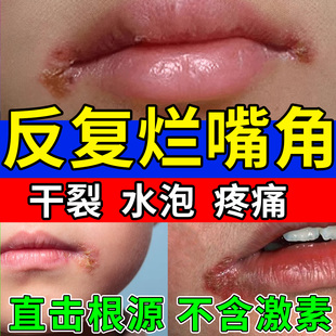 口角炎烂嘴角药膏嘴巴上火起泡开裂口干燥起皮儿童唇炎嘴唇溃疡xu