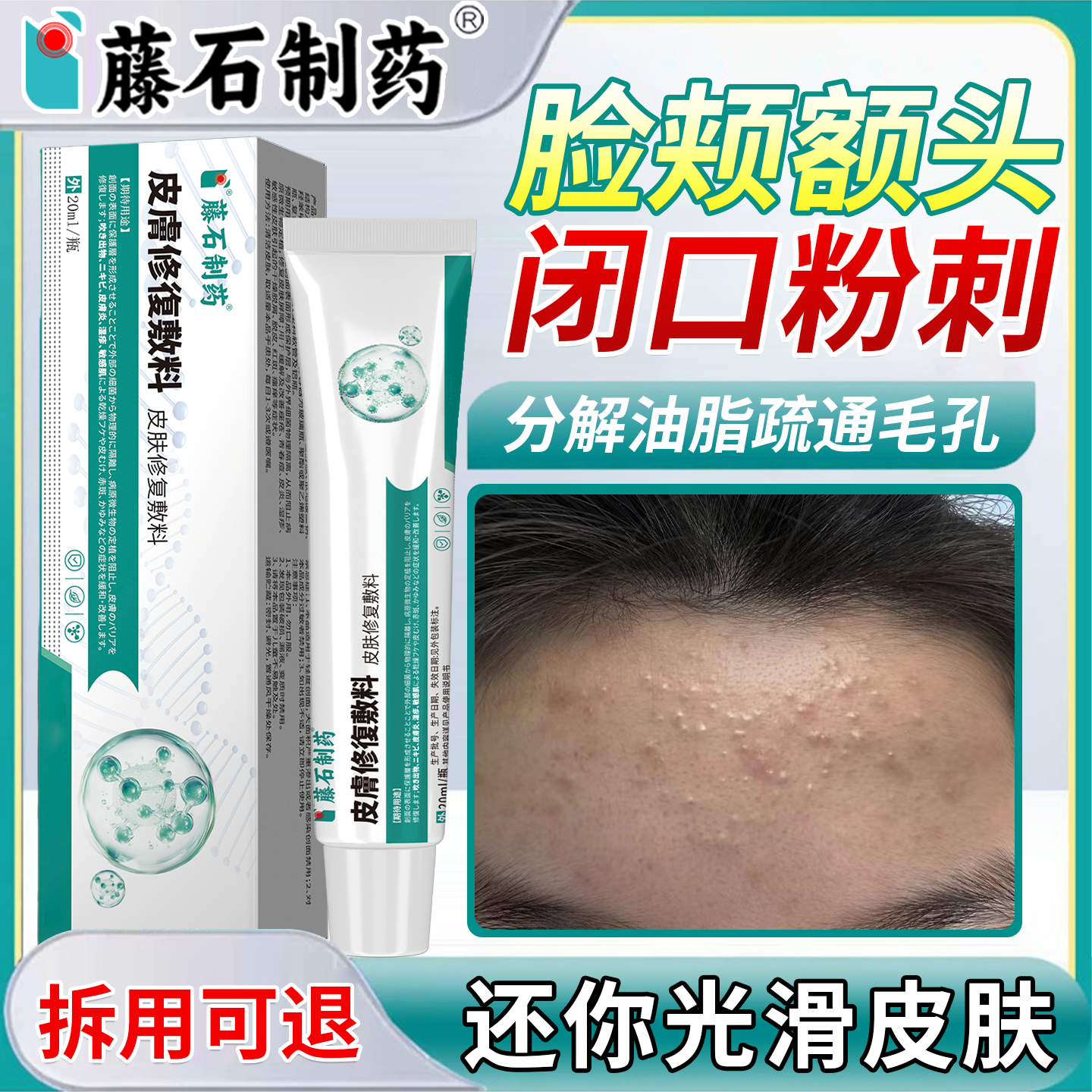 额头上闭口粉刺有脂肪粒起疙瘩去脸上痘痘皮疹修复屏障皮肤敷料OM