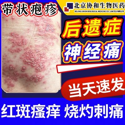 【医用级】蛇盘疮带状疱疹