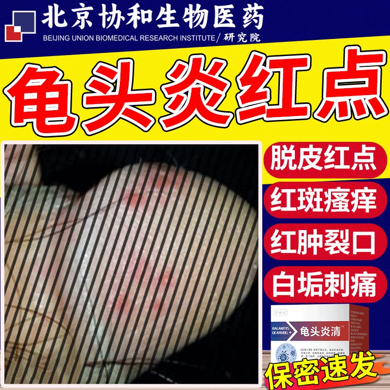 龟头上有小红点黏膜红肿裂口白垢脱皮尿道包皮炎症男性真菌感染vb