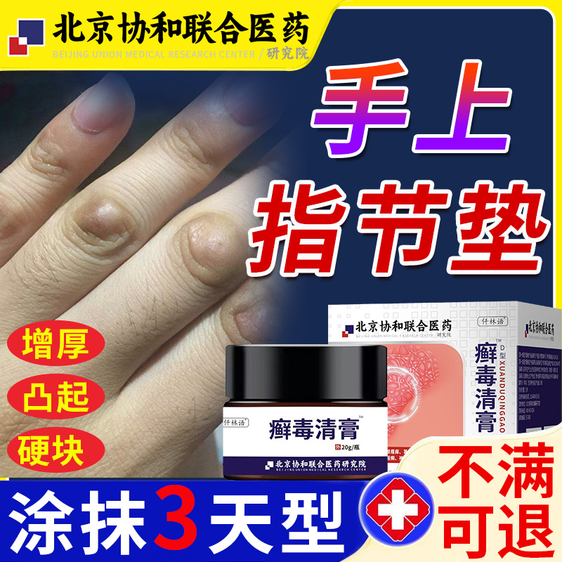 手指节垫手上凸起硬疙瘩红肿瘙痒关节癣真菌感染脱皮可搭膏药贴vb