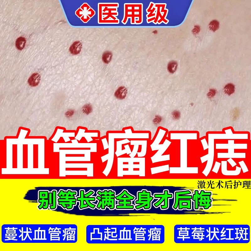 【医用级】血管瘤血管痣去除无痕