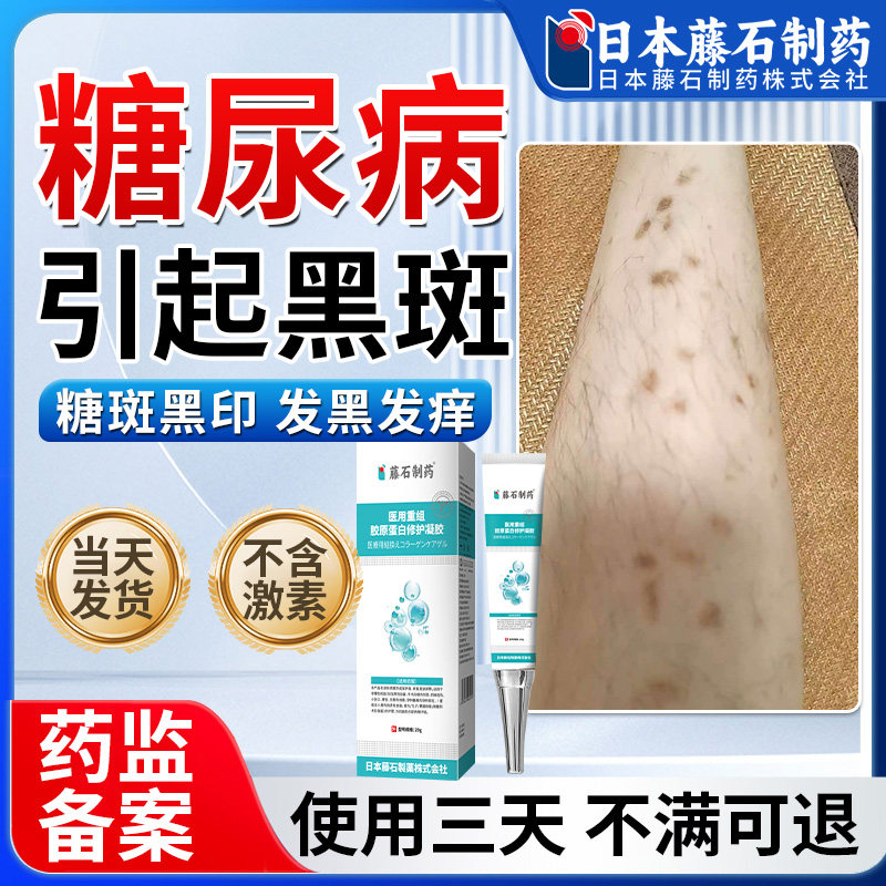 藤石制药糖尿病引起小腿黑斑去糖斑除胫前皮肤痒色素沉着烂足膏xu