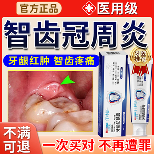 智齿牙龈肿痛可搭牙膏冠周牙疼上火牙周炎张口受限吞咽困难红肿xu