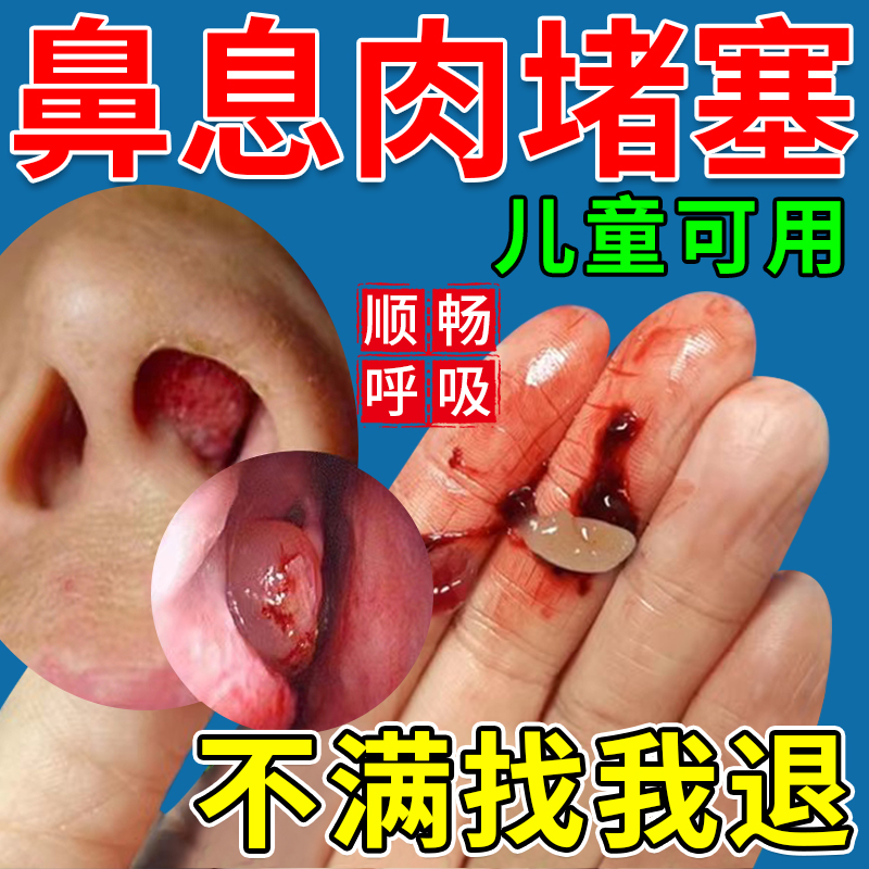 【医用级】鼻息肉无痛脱落