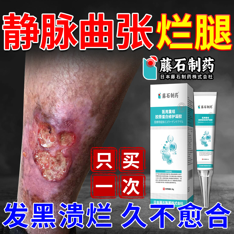 【日本品牌】脉管炎静脉曲张