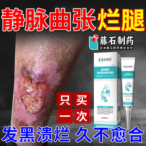【日本品牌】脉管炎静脉曲张