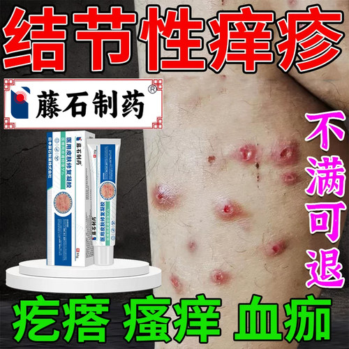 【医用级】胳膊腿上皮肤湿疹瘙痒