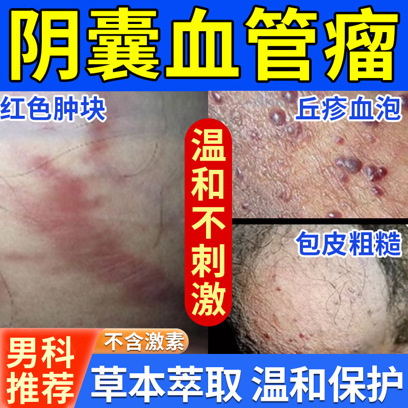 阴囊角化血管瘤血管痣黑红疙瘩蜘蛛痣红斑血泡疼生殖器阴囊感染le
