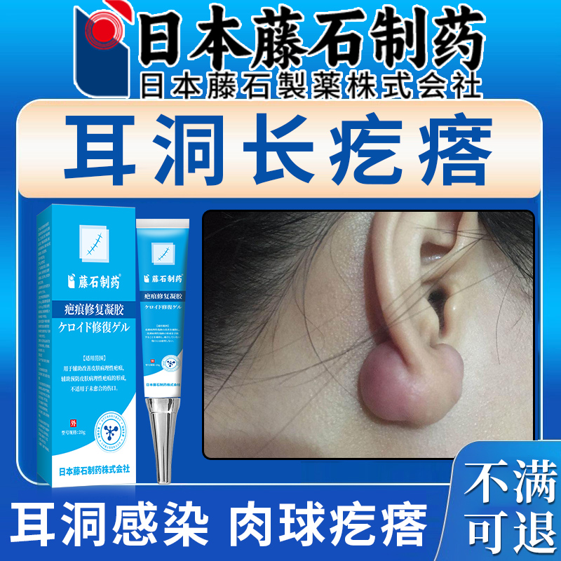 耳洞增生疤痕疙瘩专用膏耳朵凸起疙瘩鼓包瘙痒红肿灼热药房同售xu