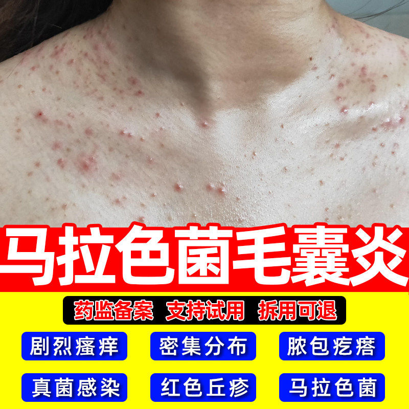 马拉色菌毛囊炎二硫化硒洗剂背上长痘痘除螨祛痘痒硫磺皂LJ