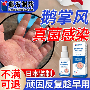 鹅掌风专用手癣搭膏药手掌脱皮干裂真菌感染角化型手部湿疹喷剂SE