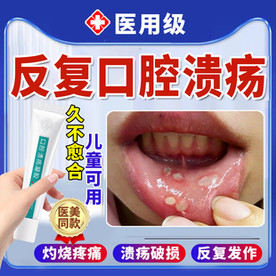 反复口腔溃疡凝胶一点灵口舌生疮专用黏膜修复液可搭牙膏喷剂QQ