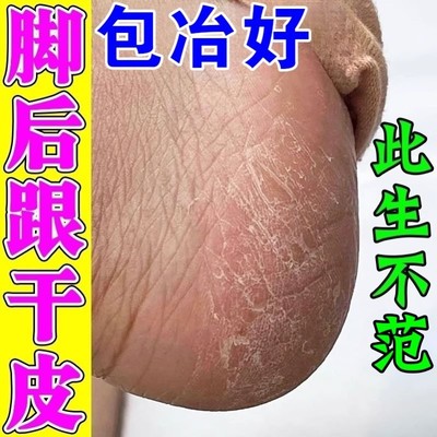 脚后跟干裂起硬皮真菌感染修复霜足跟开裂干燥脱皮角化型脚气药膏