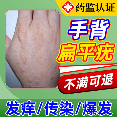 手背扁平疣去除阻断hpv可搭药膏