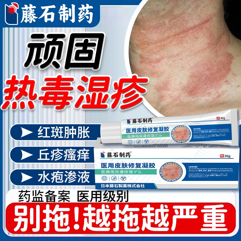热毒湿疹止痒膏专用皮肤一热就痒皮炎瘙痒祛湿痒根药房同售软膏HT