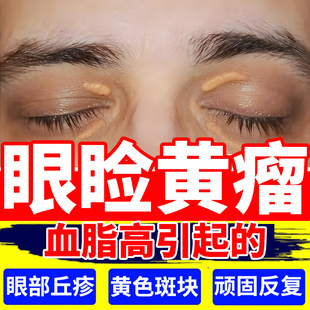 睑黄瘤去神器除色斑肉块专用可搭眼部黄斑治疗仪用的药房同售膏DS