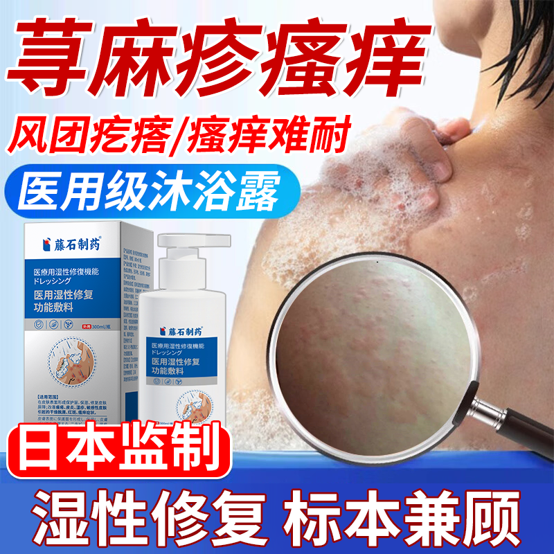 荨麻疹过敏风团疙瘩瘙痒沐浴露