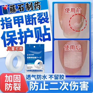 指甲保护贴防手指甲边缘开裂断裂劈了断甲修复保护套医用级儿童VQ