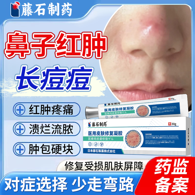 鼻子红肿长痘痘火疖子快速消肿