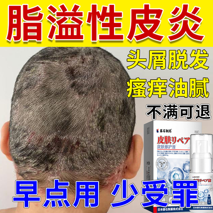 头皮屑脂溢性皮炎真菌感染头癣软膏头部治喷剂头痒非专用洗发水AR