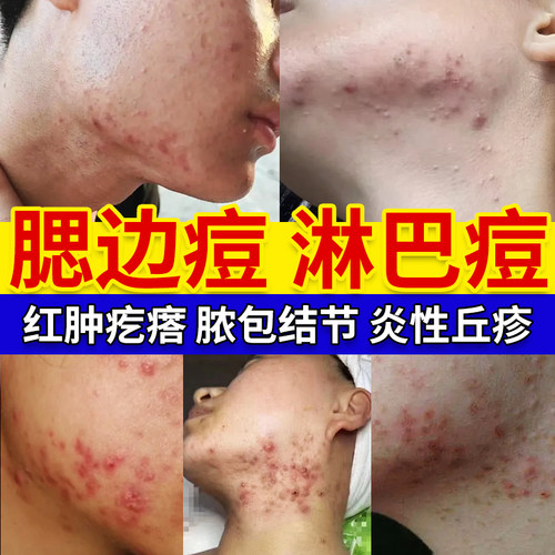淋巴痘腮边痘下巴反复长痘痤疮膏