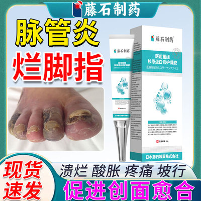 脉管炎烂脚指溃烂坡行疼痛专用