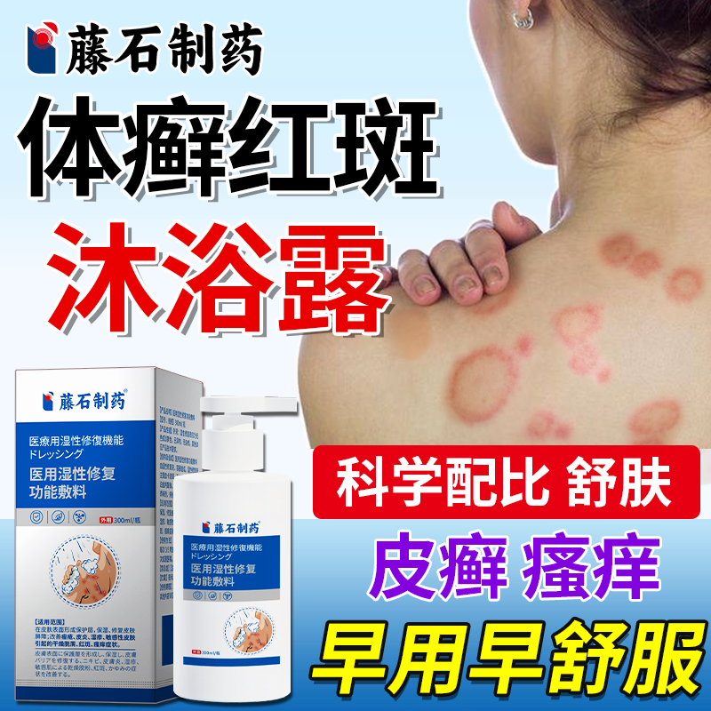 体癣沐浴露环状红斑医用款