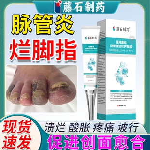 脉管炎烂脚指专用静脉曲张老烂腿外用溃烂发炎流脓药房同款YZ