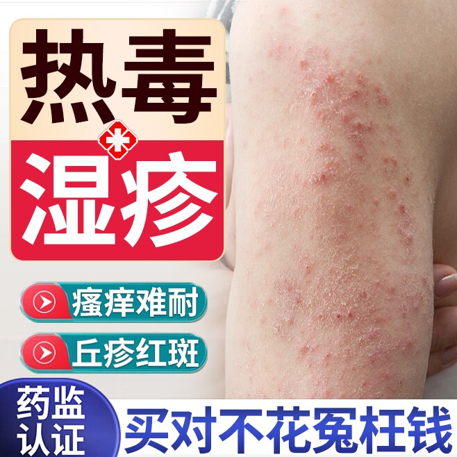 热毒血热湿疹除湿止痒膏水专用湿毒清去喷雾剂根外用顽固皮炎DS