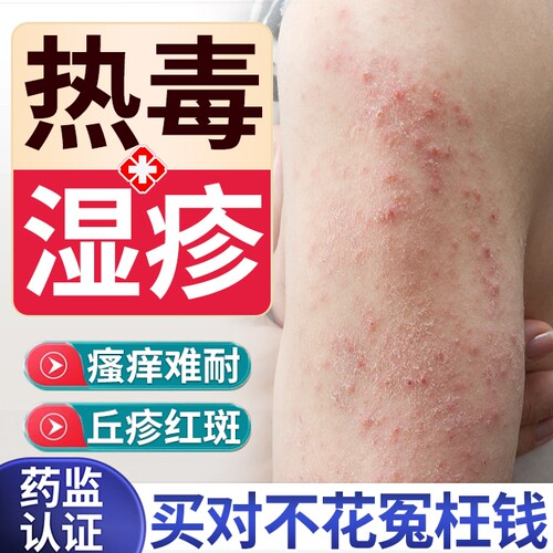 热毒血热型湿疹喷雾-药监备案