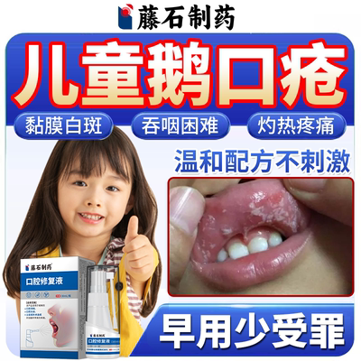 鹅口疮口腔护理液--儿童专用