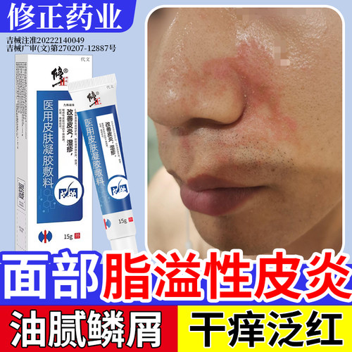 面部脂溢性皮炎--红斑鳞屑油腻