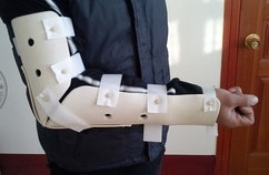 前臂肱骨裂支具代替石膏